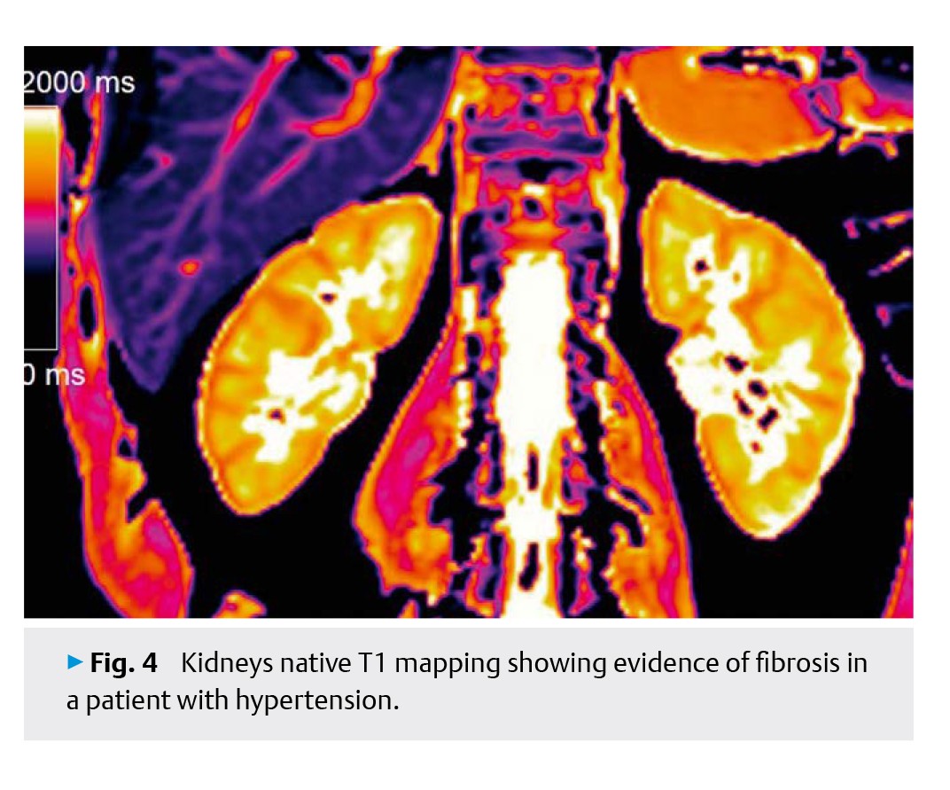 Cardiac Remodeling in Hypertension-5.jpg