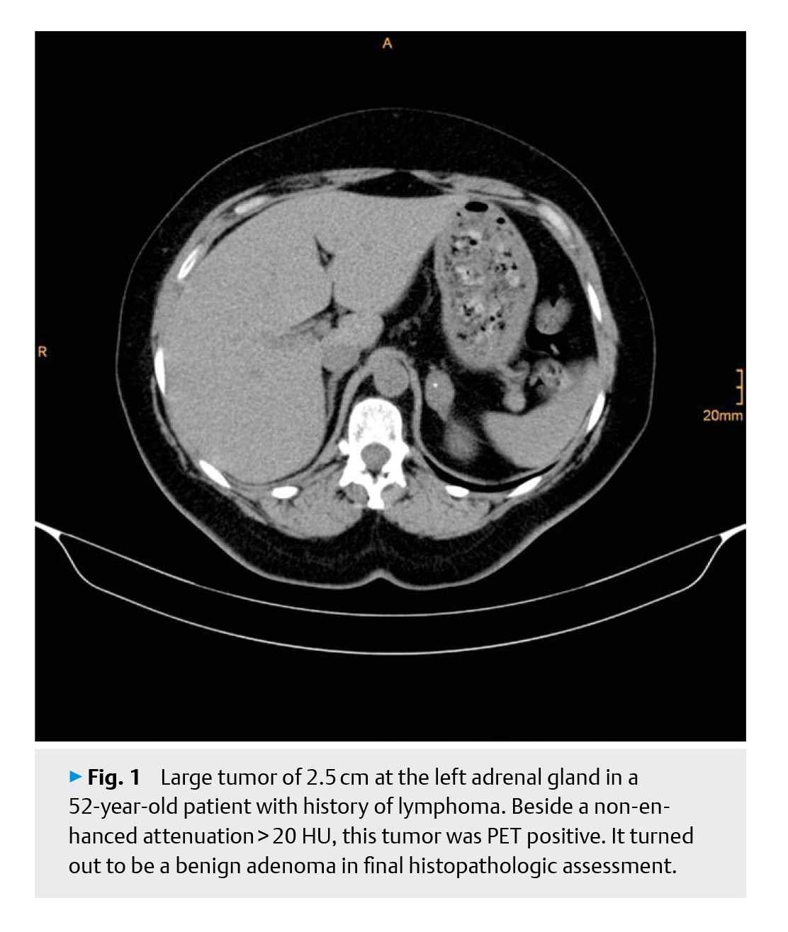 Adrenal Surgery in the Era-5.jpg
