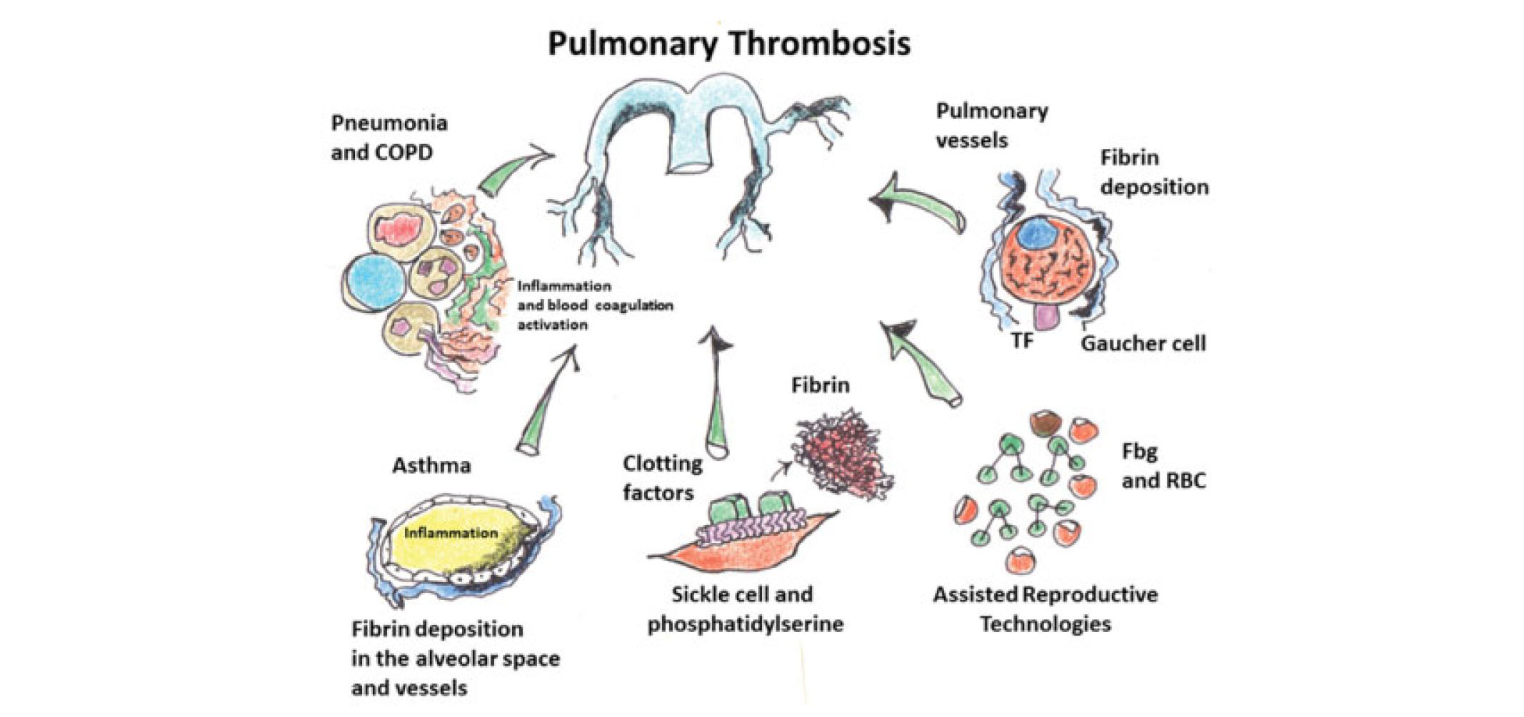 Pulmonary Thrombosis-5.jpg