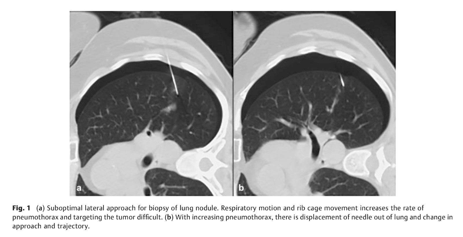 Lung Ablation-4.jpg
