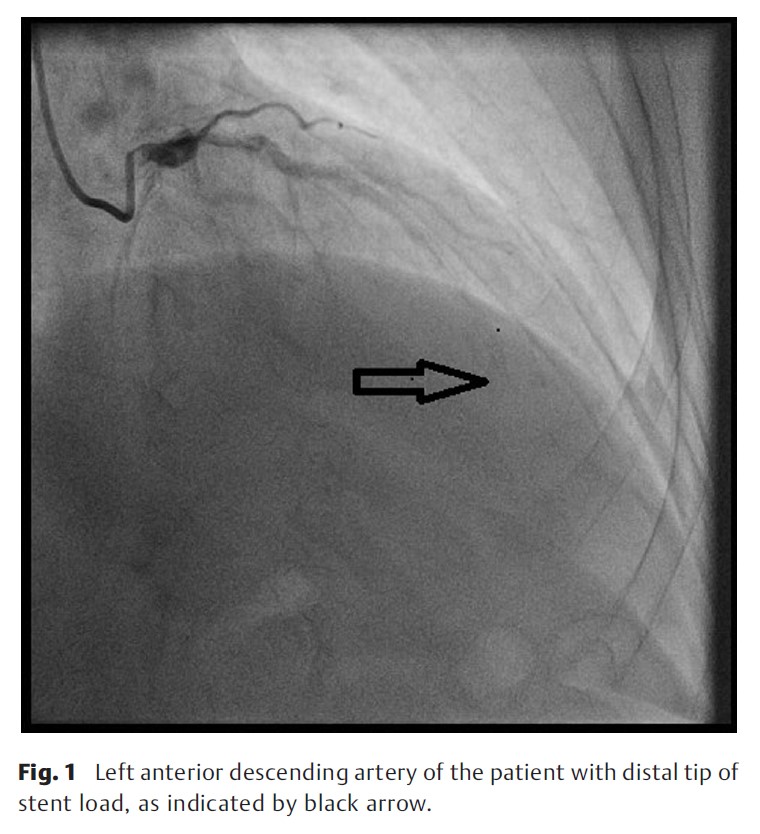 Coronary Anastomosis In Stent.jpg