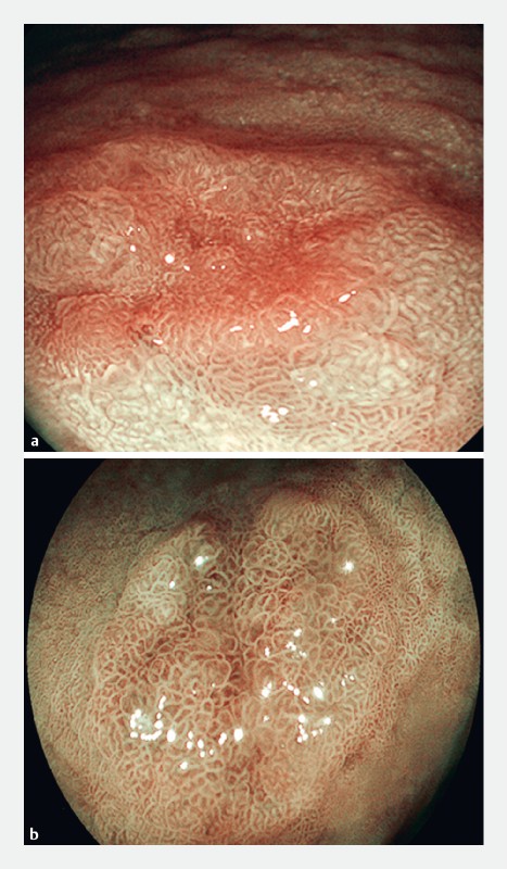 Management of epithelial.jpg
