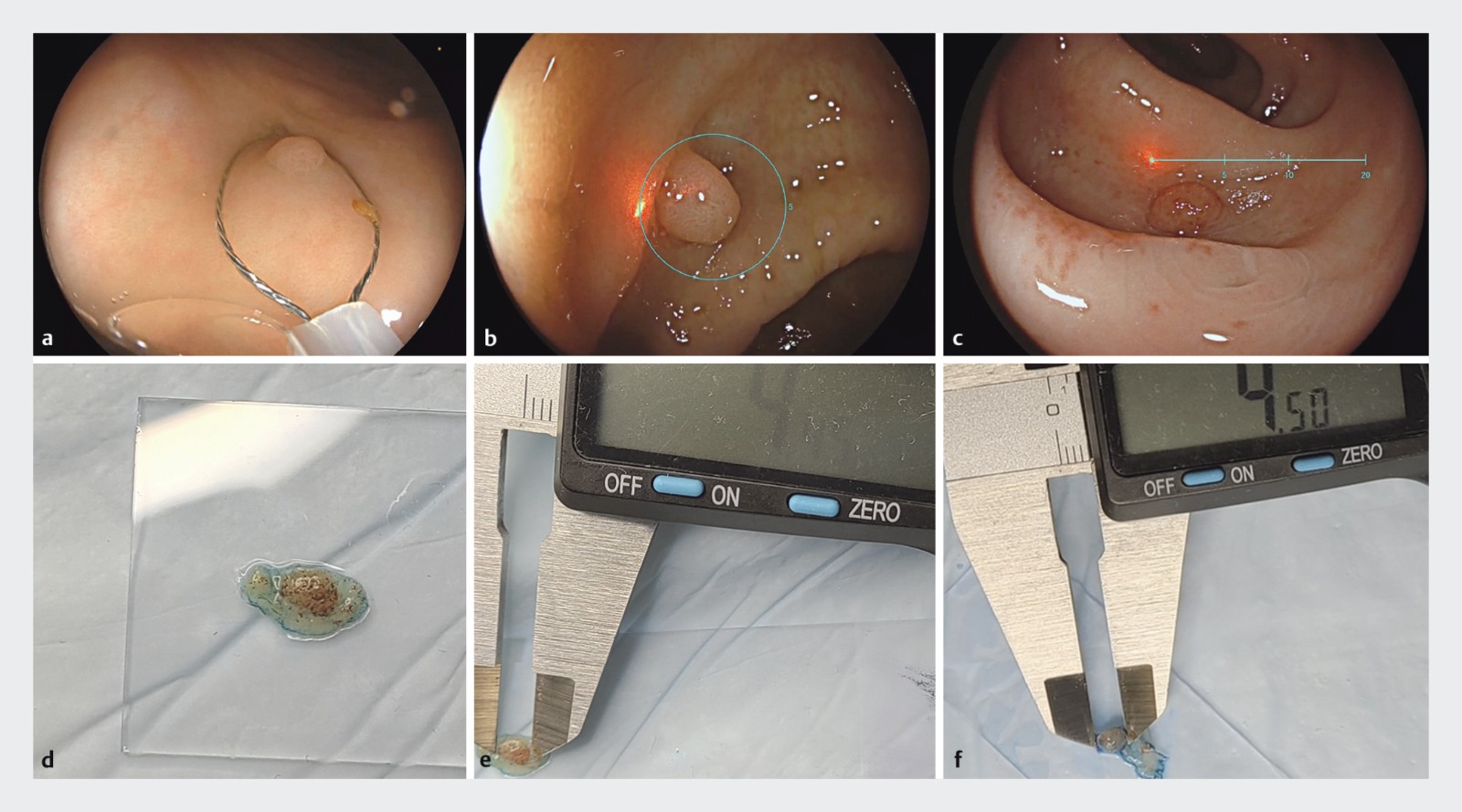 Virtual scale endoscope.jpg