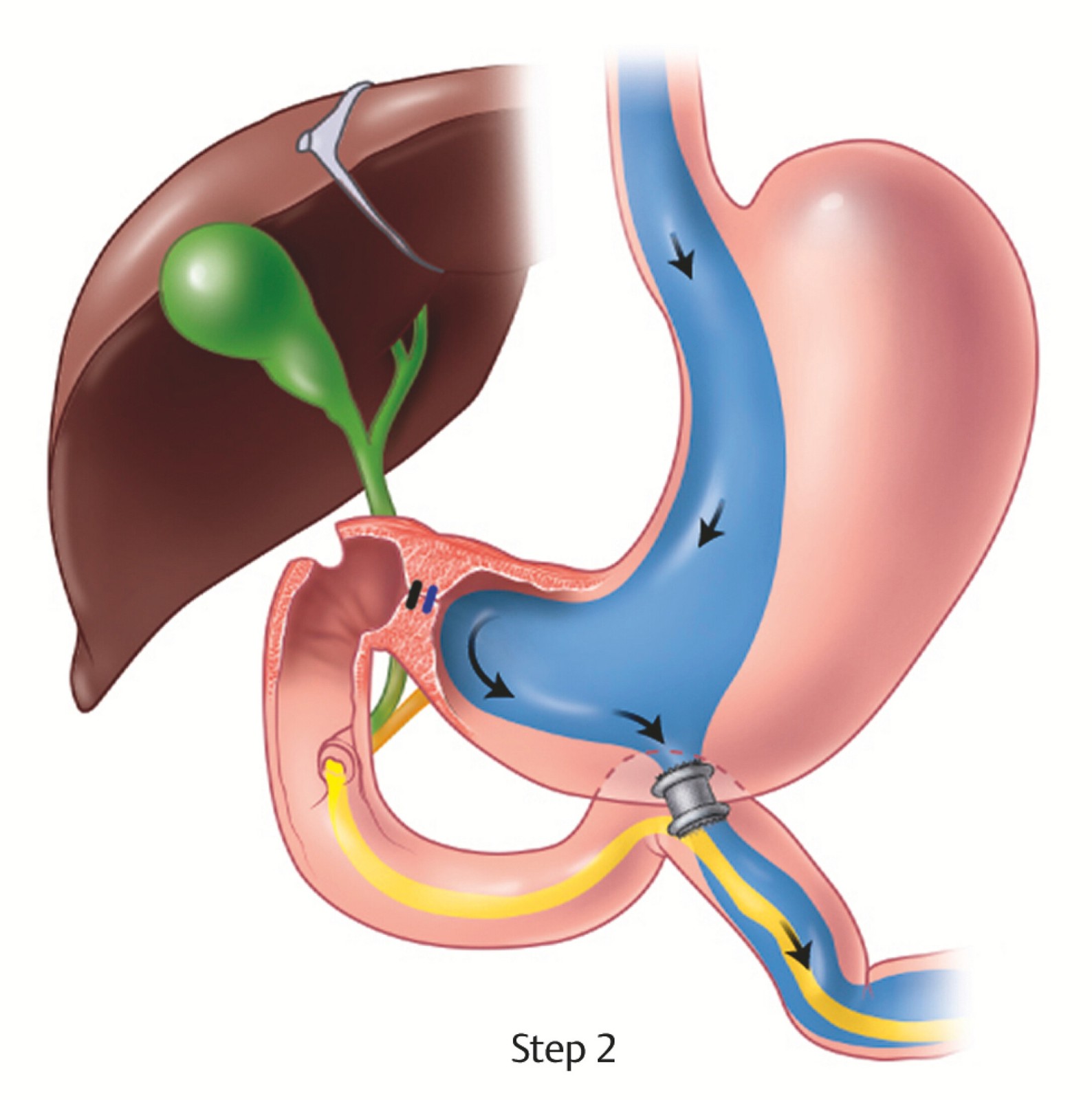 Reversible endoscopic.jpg