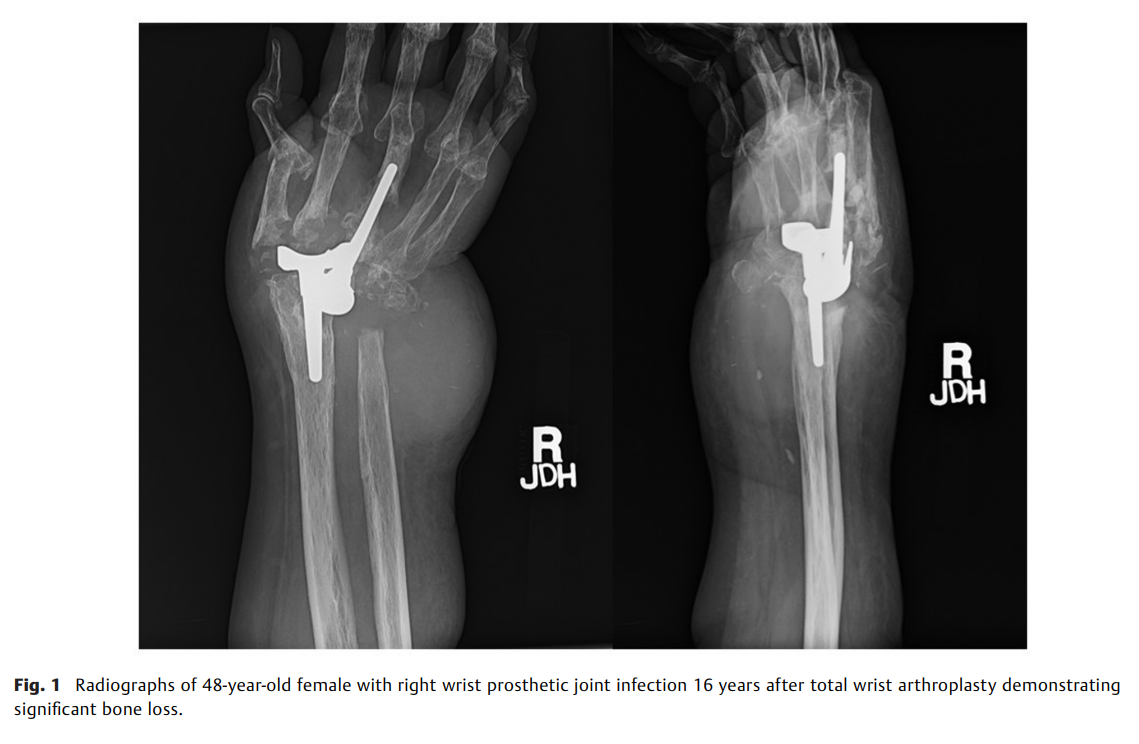 Wrist Arthrodesis with Double.png