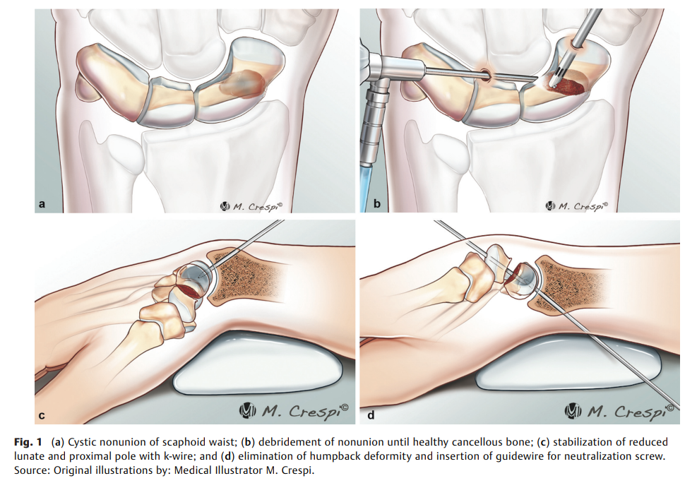 Percutaneous Neutralization Screw.png