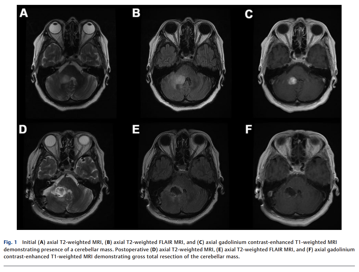 Intracranial Retrograde 2.png