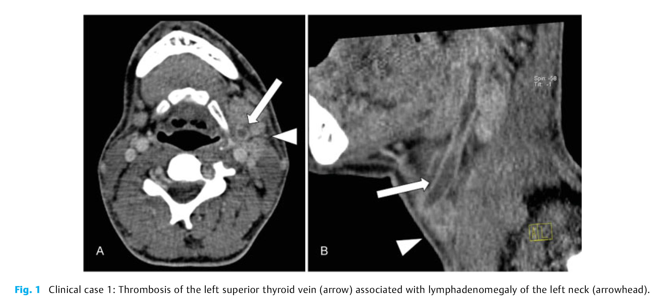 Lemierre Syndrome-3.jpg