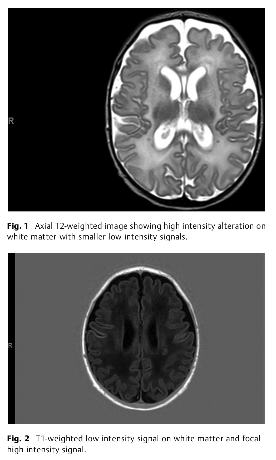 High Blood Pressure in a Urea Cycle Disorder Case Report-2.jpg