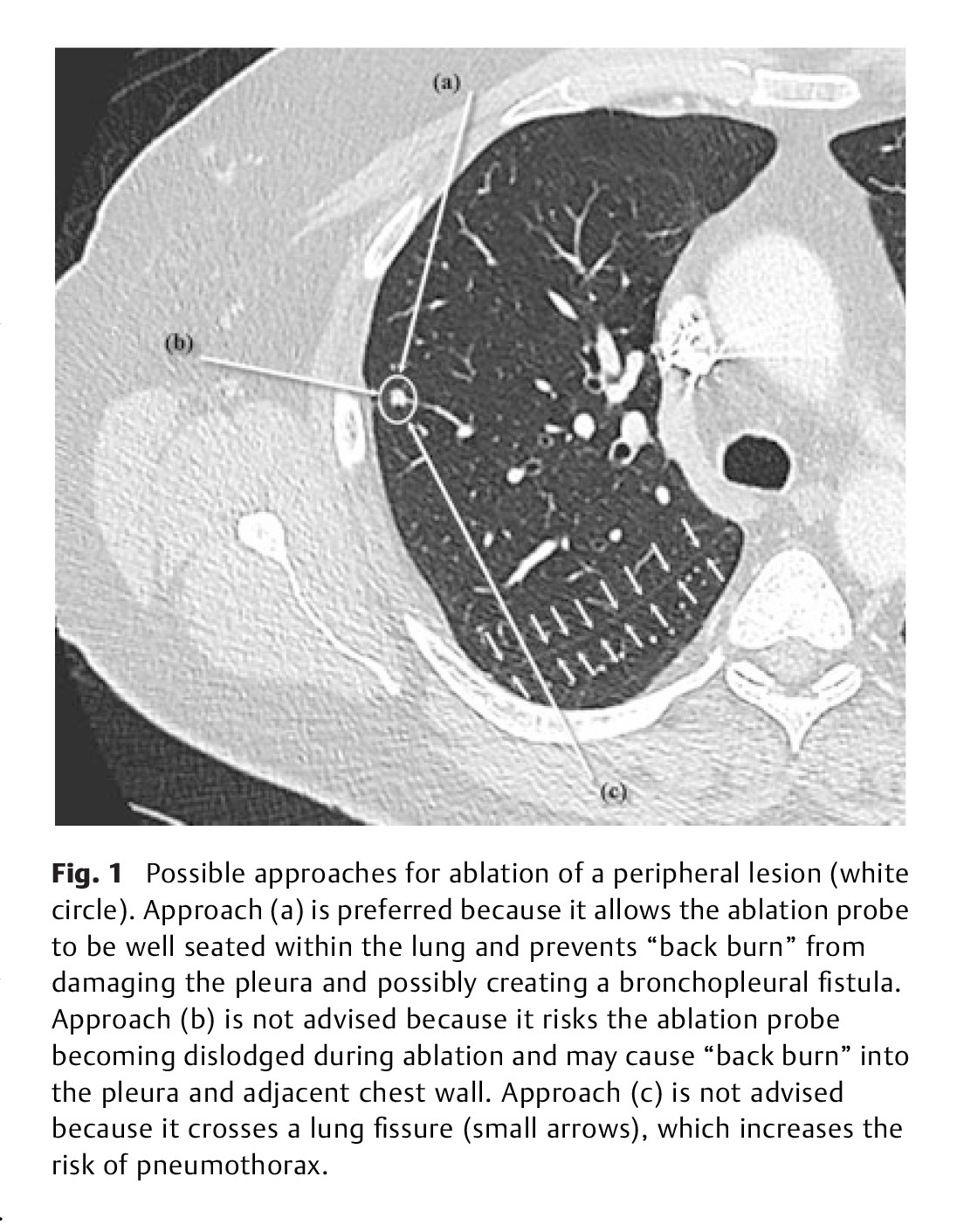 Microwave Ablation-3.jpg