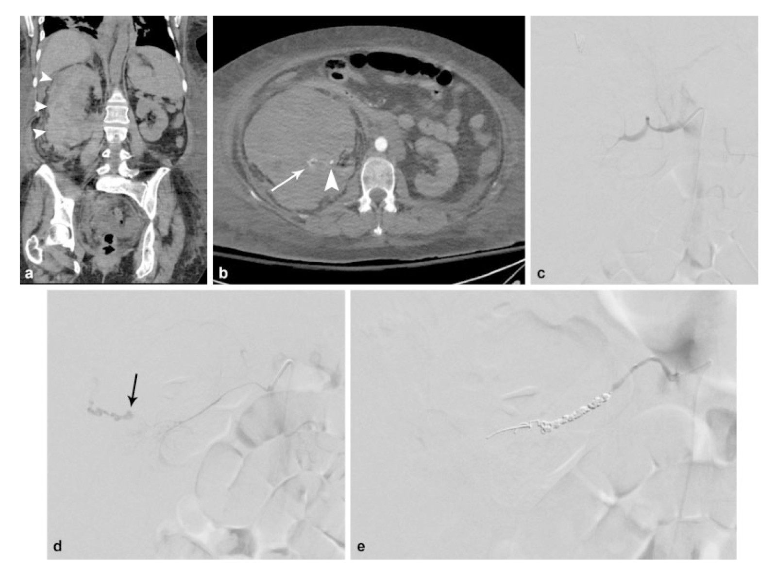 Complications of Percutaneous-2.jpg