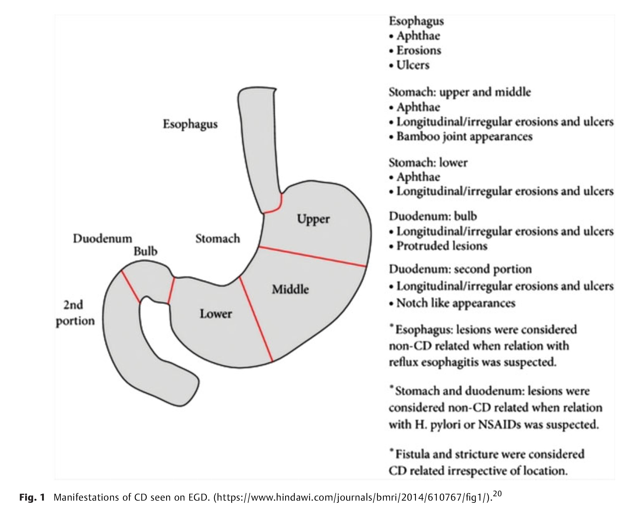Crohn’s Disease of t-5.jpg