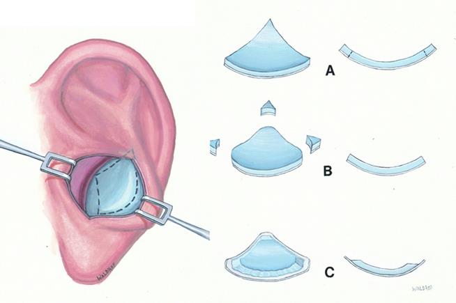 Butterfly Graft.jpg