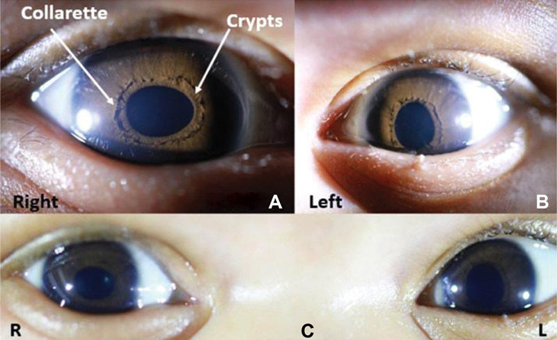 A Newborn Infant with Congenital.jpg