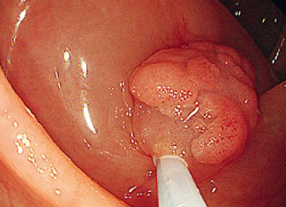 Anchoring endoscopic.jpg