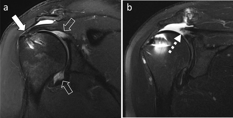 Rotator Cuff.jpg