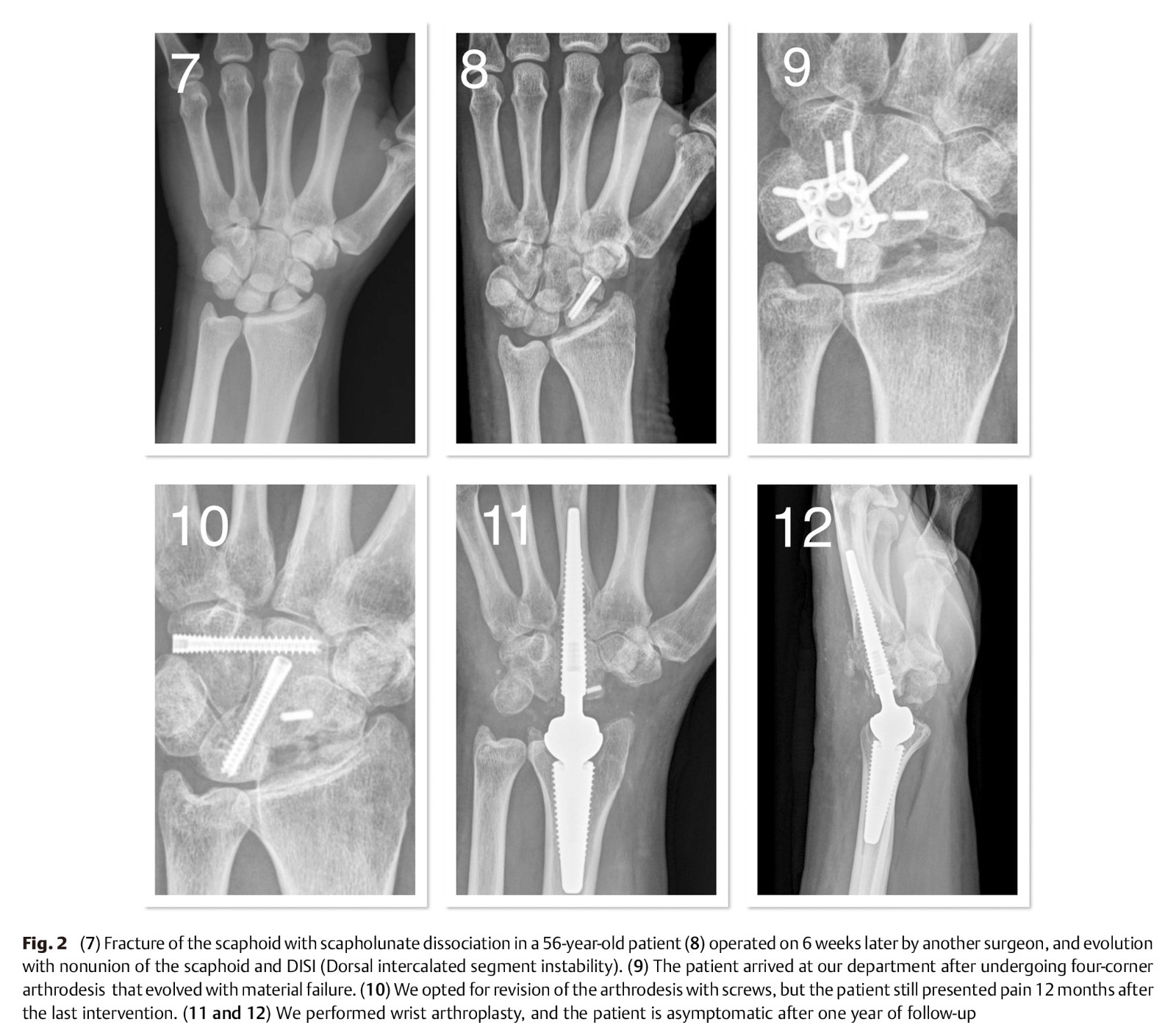 Wrist Arthroplasty as a Solution-5.jpg