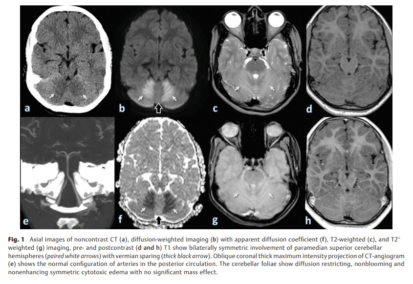 A Novel Neuroimaging Phenotype.jpg