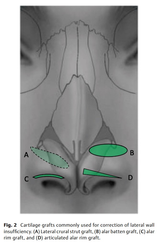 Management of Lateral Wall Insufficiency.jpg