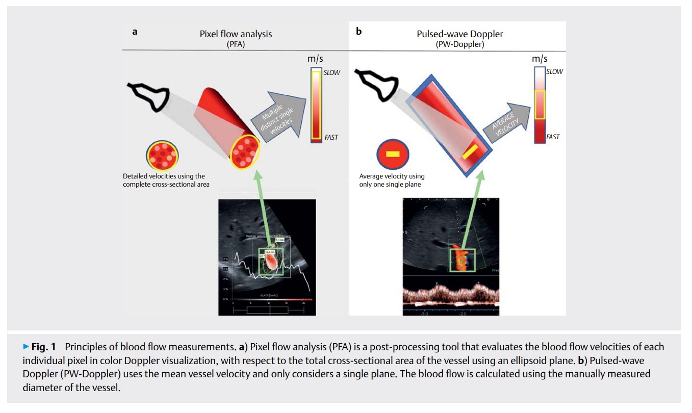 Quantification of Portal Vein Vascularization Using.jpg