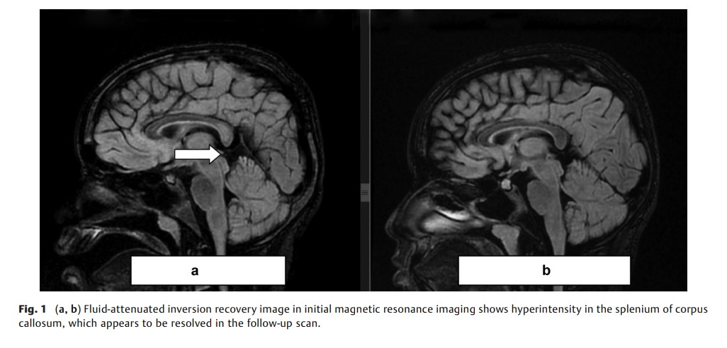 A Rare Case of Encephalopathy.jpg