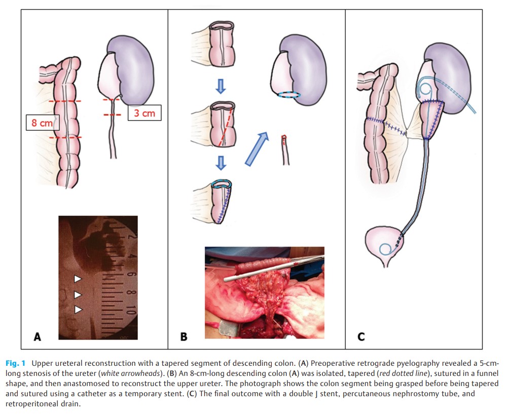 Upper Ureteral Reconstruction.jpg