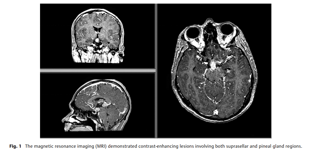 Intraoperative Germinoma Staining 2.png