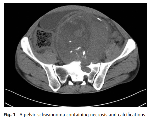 Analysis of Benign Retroperitoneal 2.png