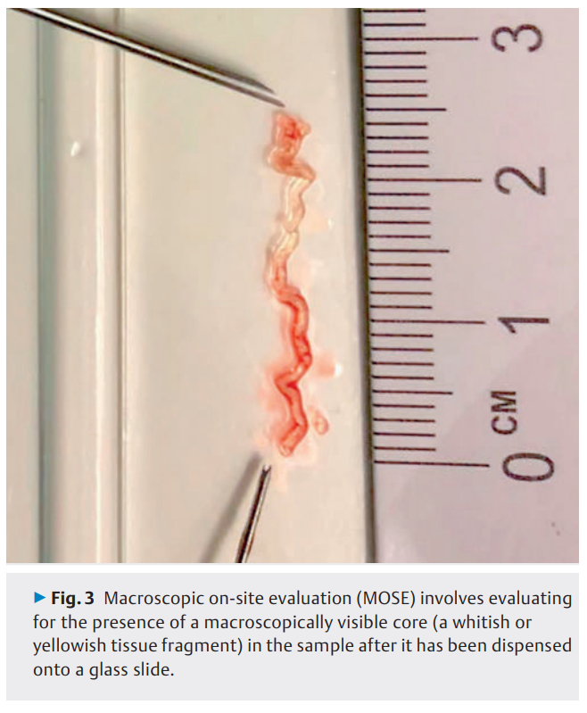 Endoscopic ultrasound-guided 2.png