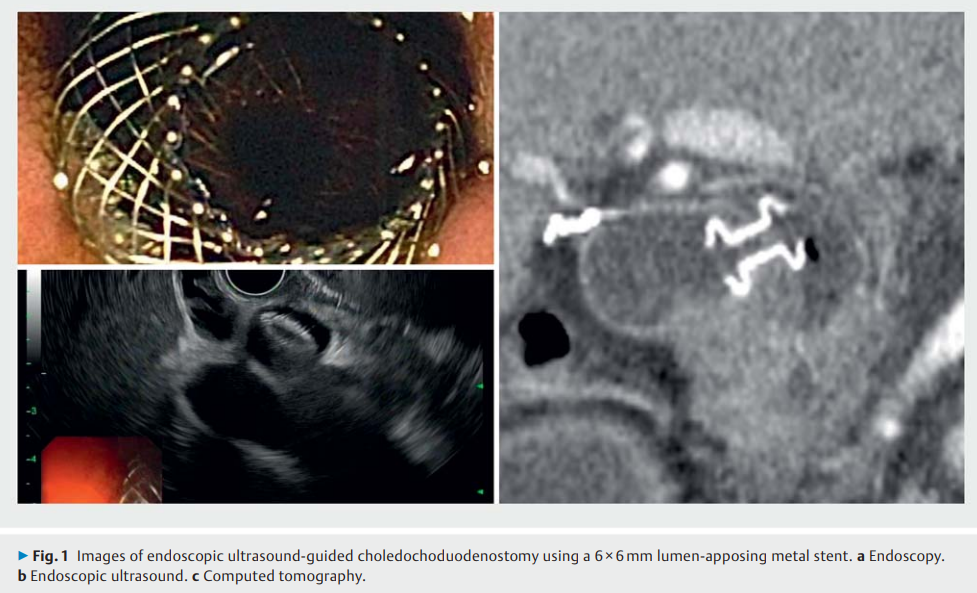 Stent misdeployment and factors 2.png