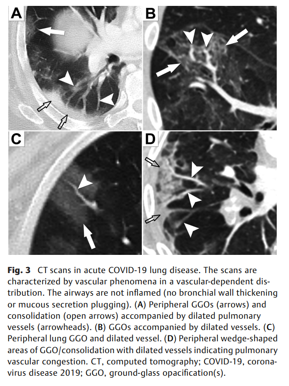 Vascular Pathogenesis 2.png