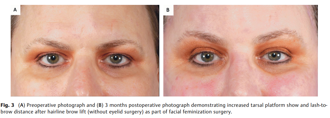 Effect of Facial Feminization 2.png