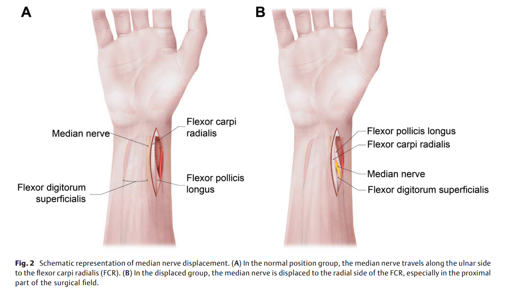Median Nerve Displacement.png