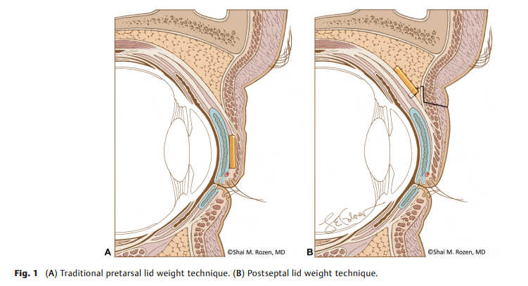 Upper Eyelid Postseptal 2.png