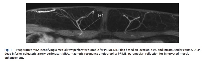 Introducing the PRIME DIEP Flap 2.png
