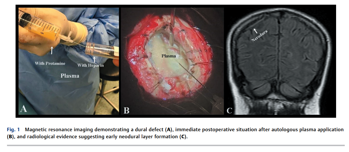 6a0aba2836267.png Duraplasty with Autologous Blood 2.png