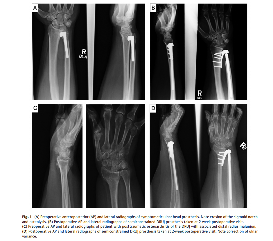 6a0eb142782d5.png Semiconstrained Distal.png