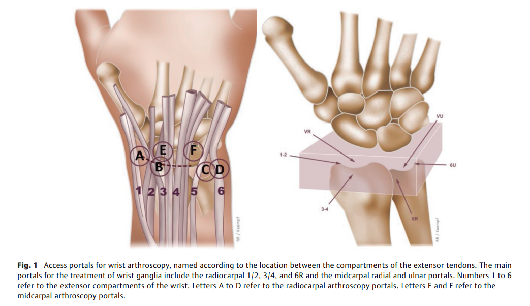 6a0eb15272ccb.png Arthroscopic Resection.png