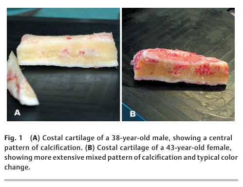 6aa8f38432896.png Costal Cartilage Calcification 2.png