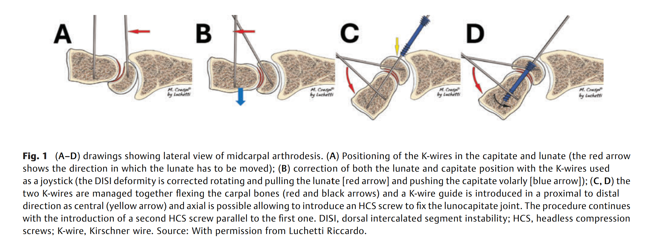 6acedb58a5249.png Two-Column Intercarpal 2.png