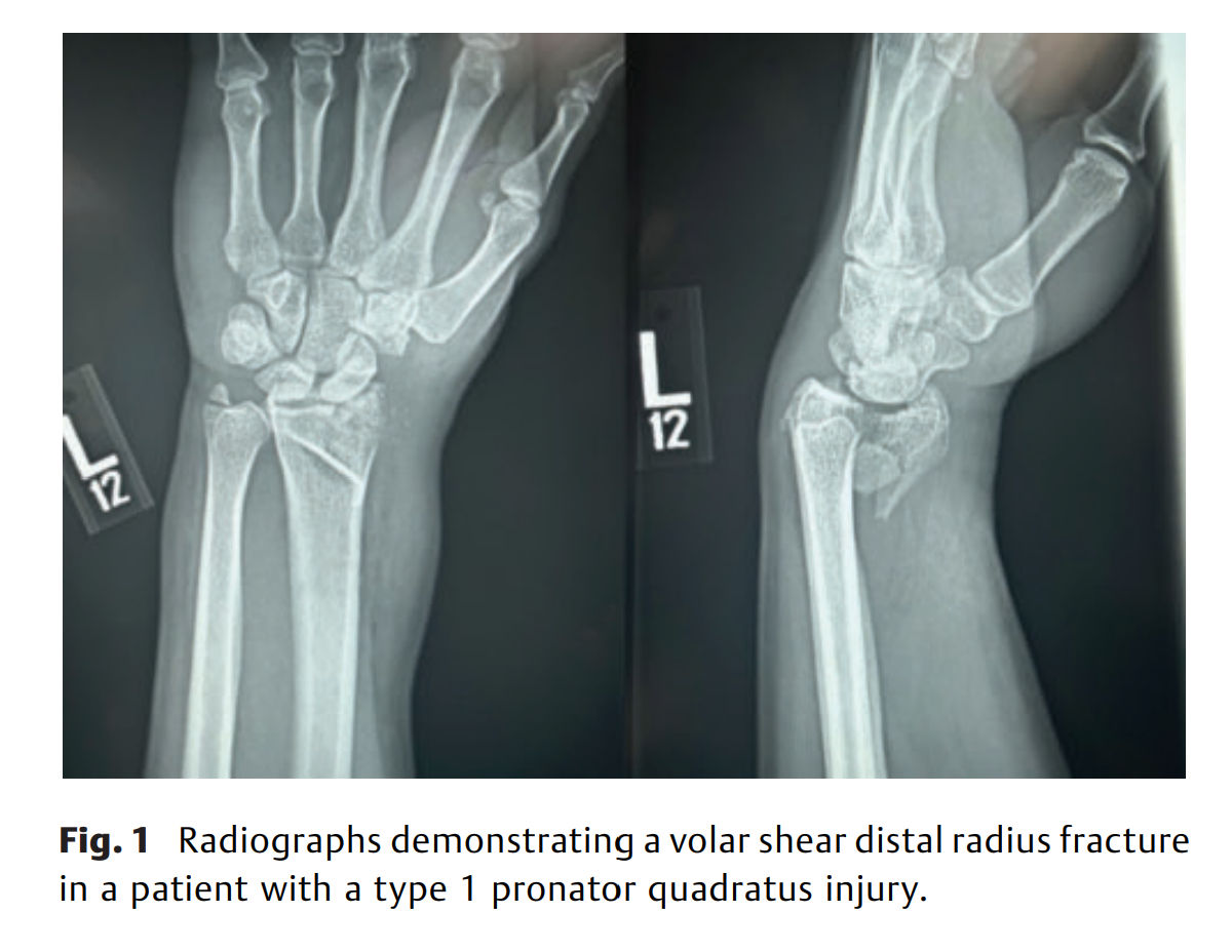 6acedb6d5b278.png Distal Radius Fracture Pattern 2.png